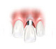 Front-Zahn Sanierung